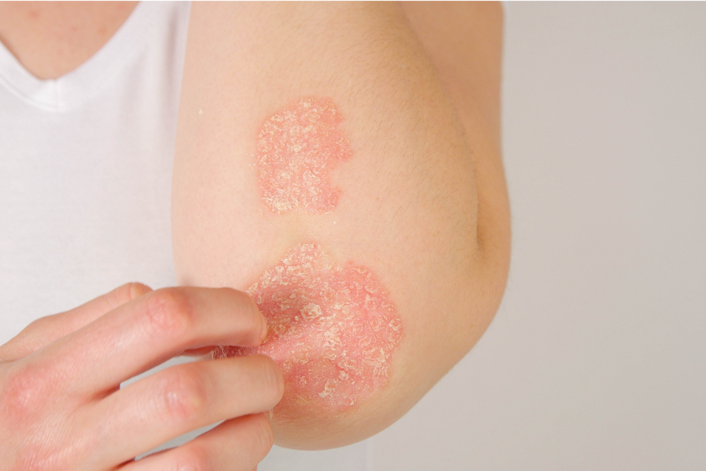 Gut-skin connection